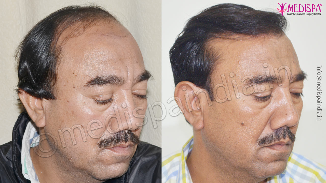 Hair Transplant Results in Jaipur, Rajasthan - Medispa India Hair Transplant Results in Jaipur, Rajasthan - Medispa India