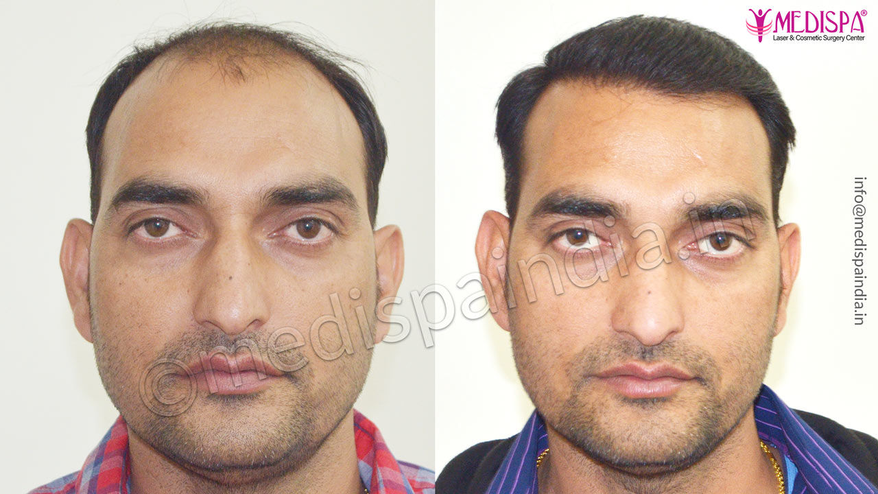 Best Hair Transplant After 6 Month Results | Medispa India Best Hair Transplant After 6 Month Results | Medispa India