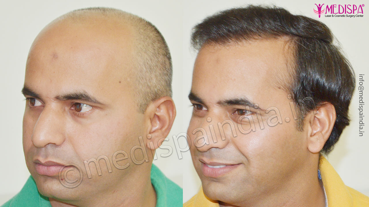 Hair Transplant Surgery Results, Before and After Photos Top Hair
