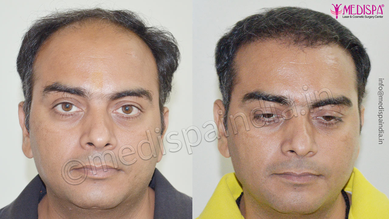 Photo Gallery  Hair Restoration Results in Surat  Medispa