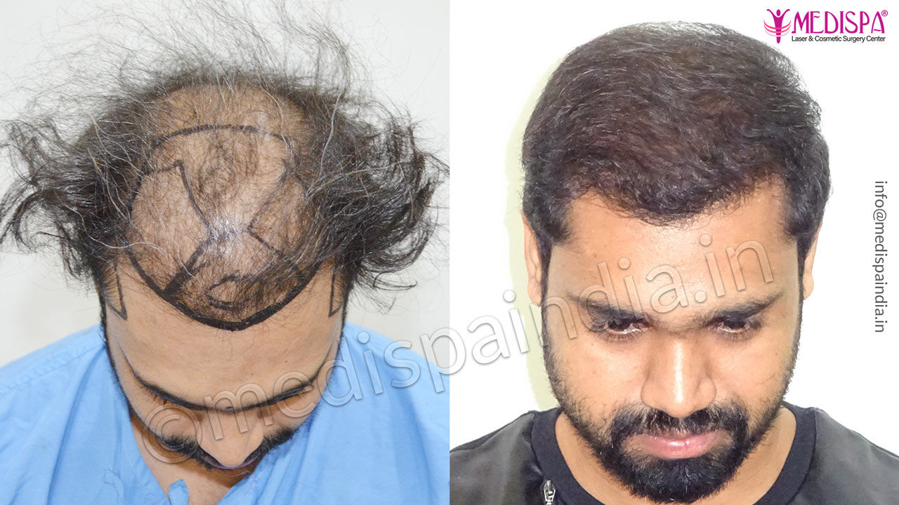 Radiant Aesthetics Clinic  Hair Transplant Surgeon in Mumbai Fue Hair  Transplant in mumbai prp treatment in Andheri