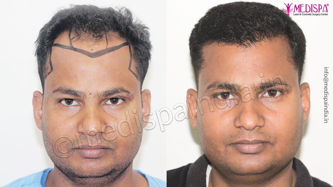 Hair Transplant Results - Madhya Pradesh Hair Transplant Results - Madhya Pradesh
