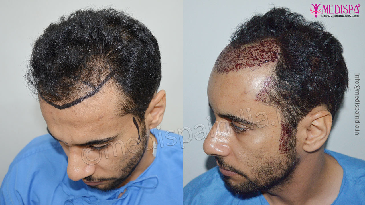 Hair Transplant Before & After Photos Dubai, UAE