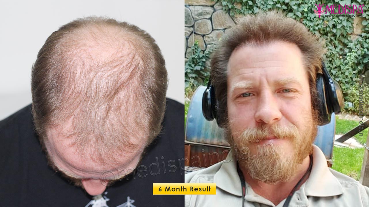 Hair Transplant USA Results Before & After Photos