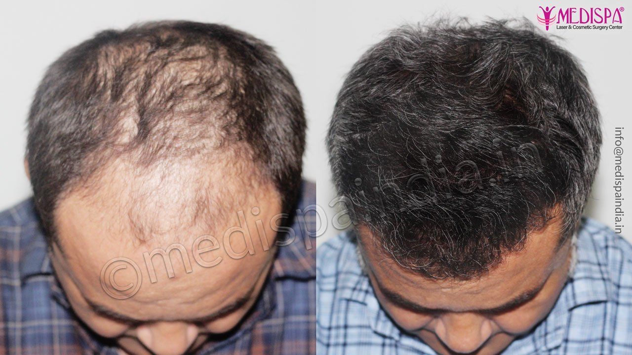 Best Hair Transplant Results Dubai UAE Medispa India