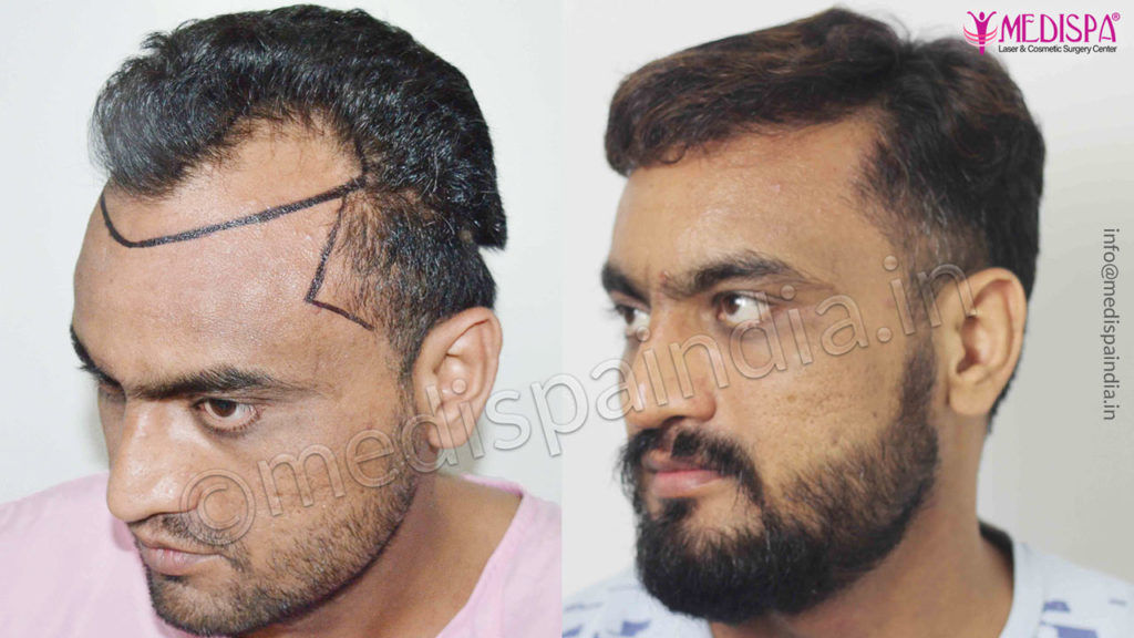 Hair Transplant Before & After Photos Australia