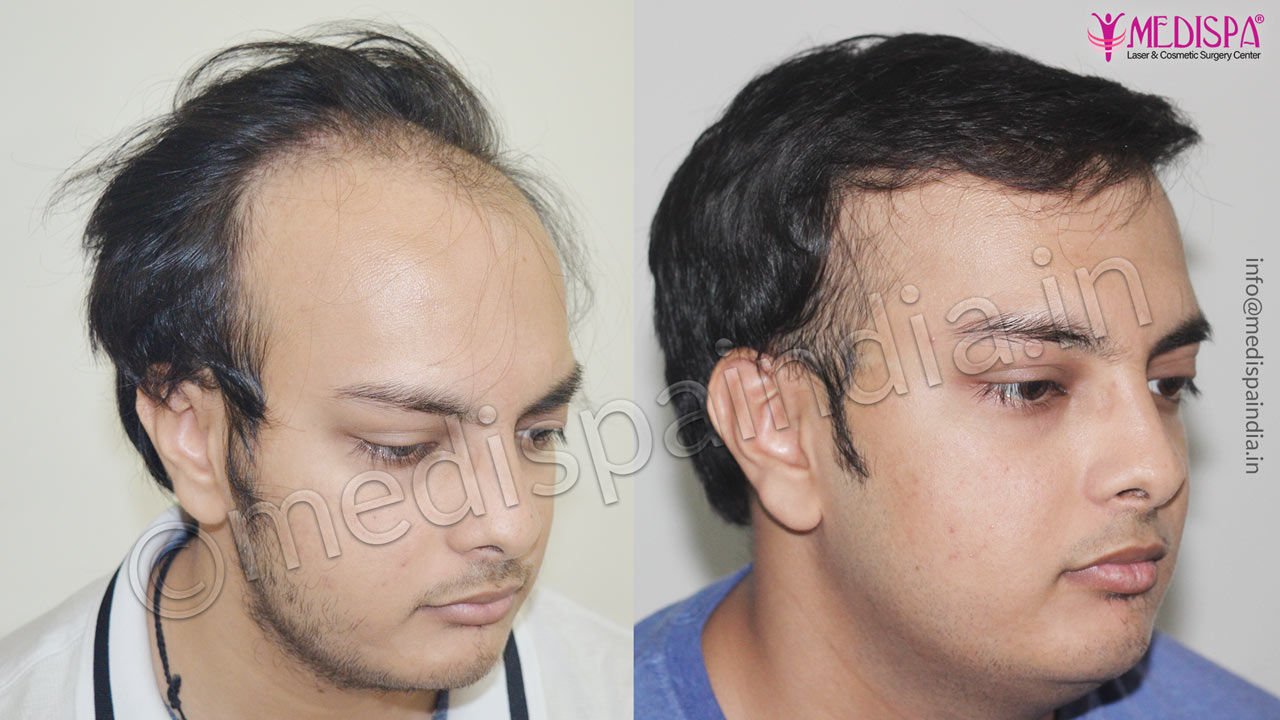 Hair transplant Jodhpur, Rajasthan Hair transplant Jodhpur, Rajasthan