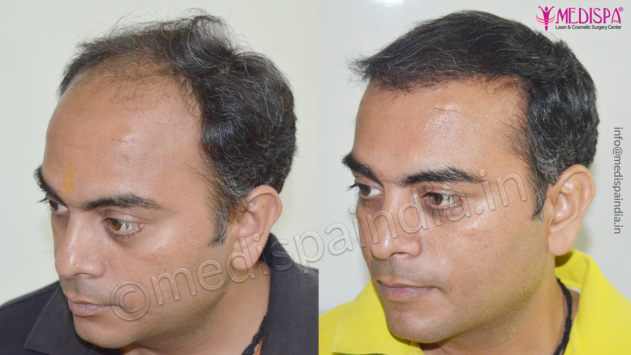 Best Hair Transplant in Surat  Top Cosmetic Clinic  Dr Smart Clinic