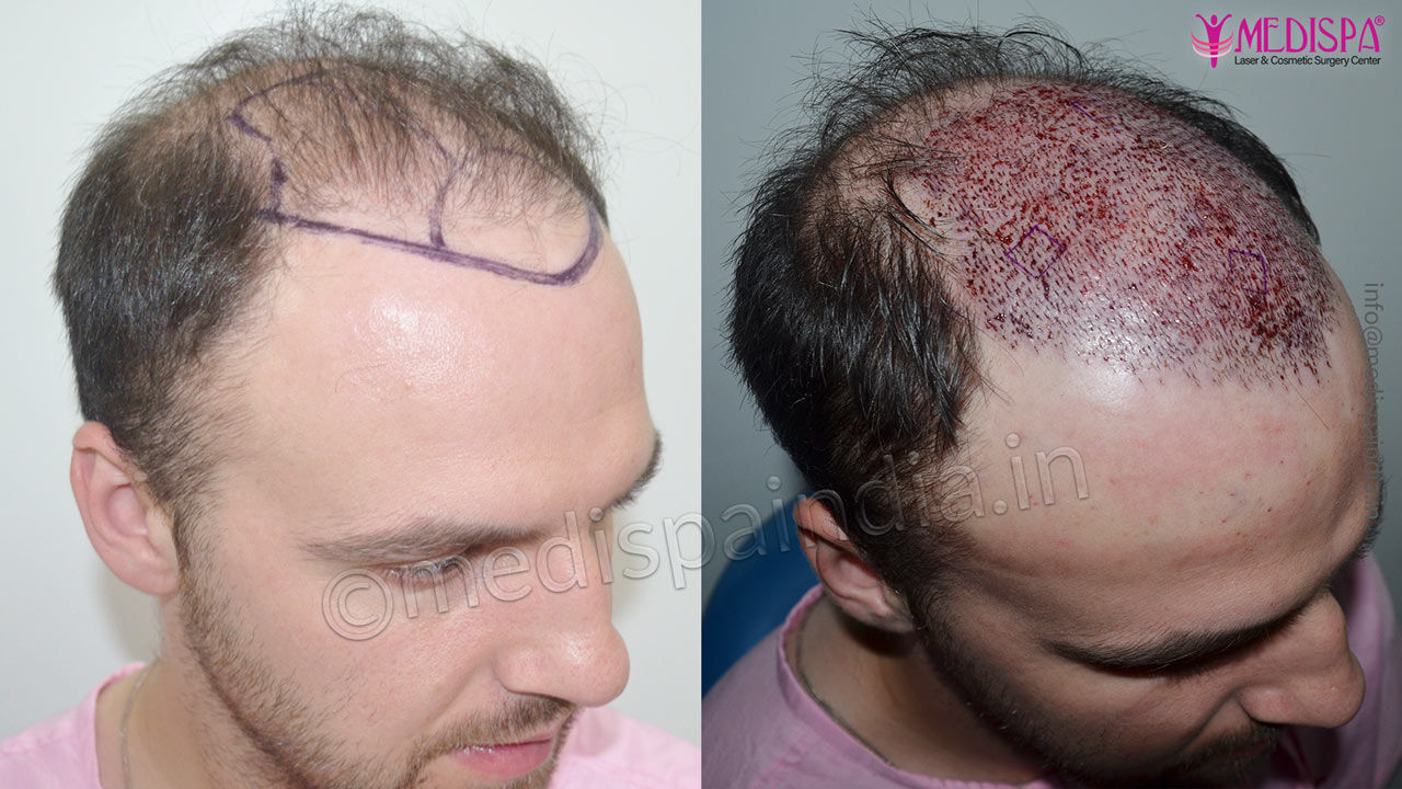 Ireland Hair Transplant Results | Before & After Photos Ireland Hair Transplant Results | Before & After Photos