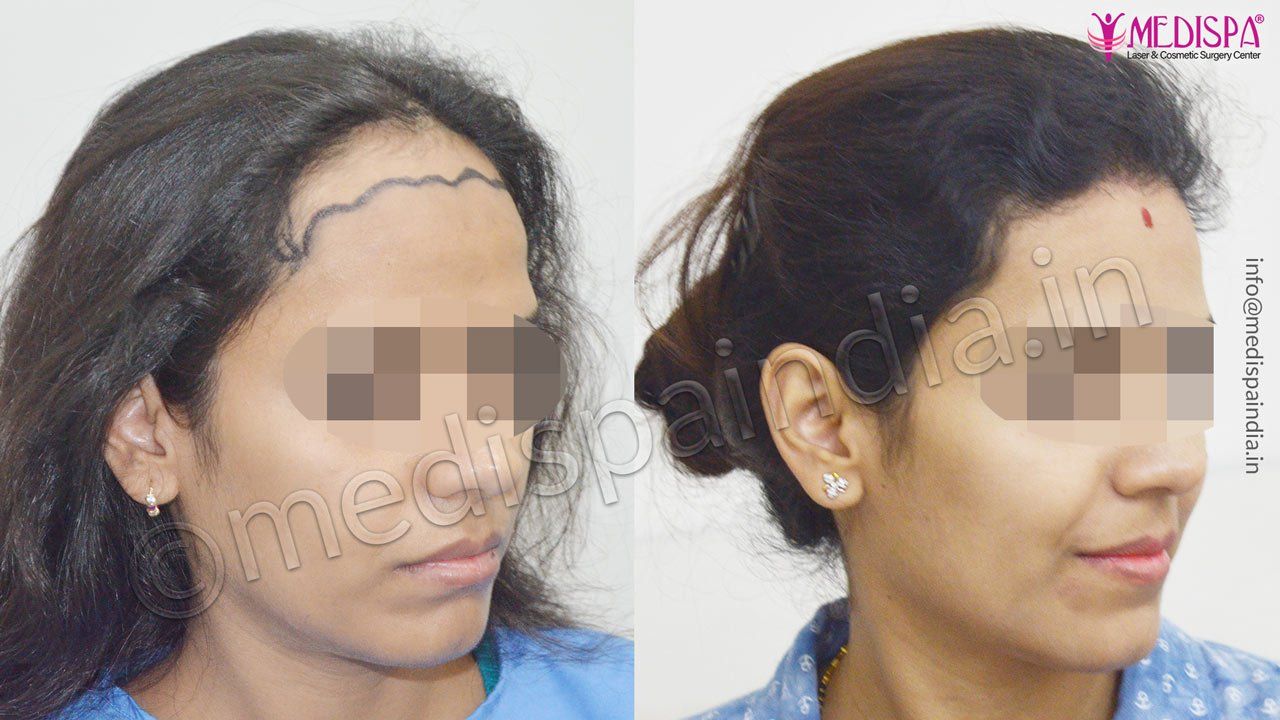 Before after hair transplant in Pune Maharashtra India