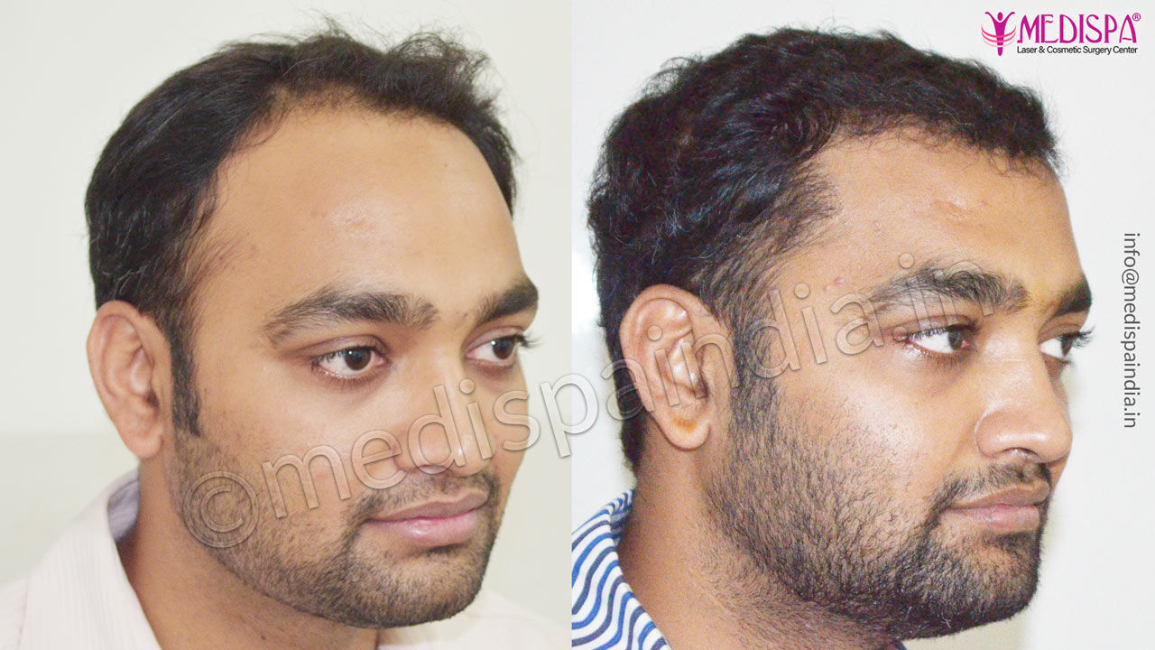 Top more than 66 hair transplant clinic in kolkata super hot in.eteachers