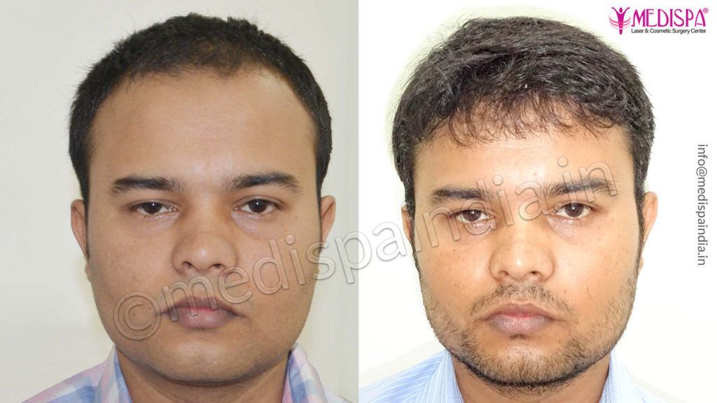 Hair Transplant Dubai Cost  Medispa Hair Transplant Clinic