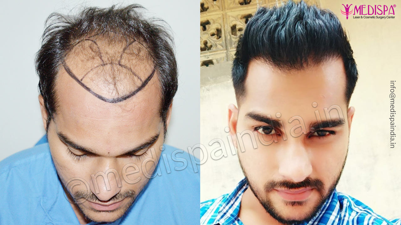 Male Hair Transplant Photo Gallery 5 | Top Hair Transplant Center Delhi ...