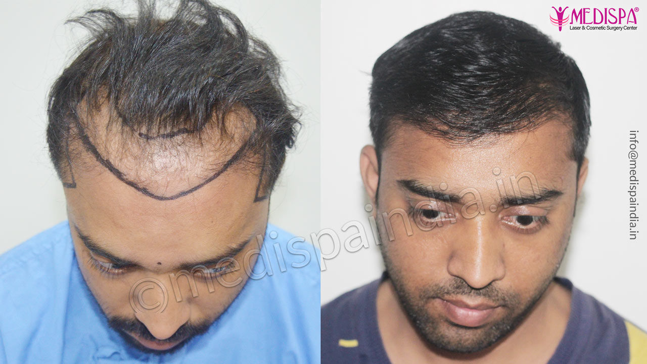 Before after hair transplant in Pune, Maharashtra, India Before after hair transplant in Pune, Maharashtra, India