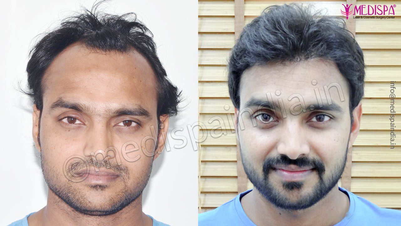 Male Hair Transplant Results | Best Hair Transplant Results Male Hair Transplant Results | Best Hair Transplant Results