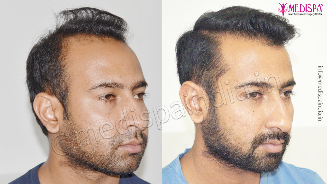 Best Hair Transplant Results in Delhi, Before After Results