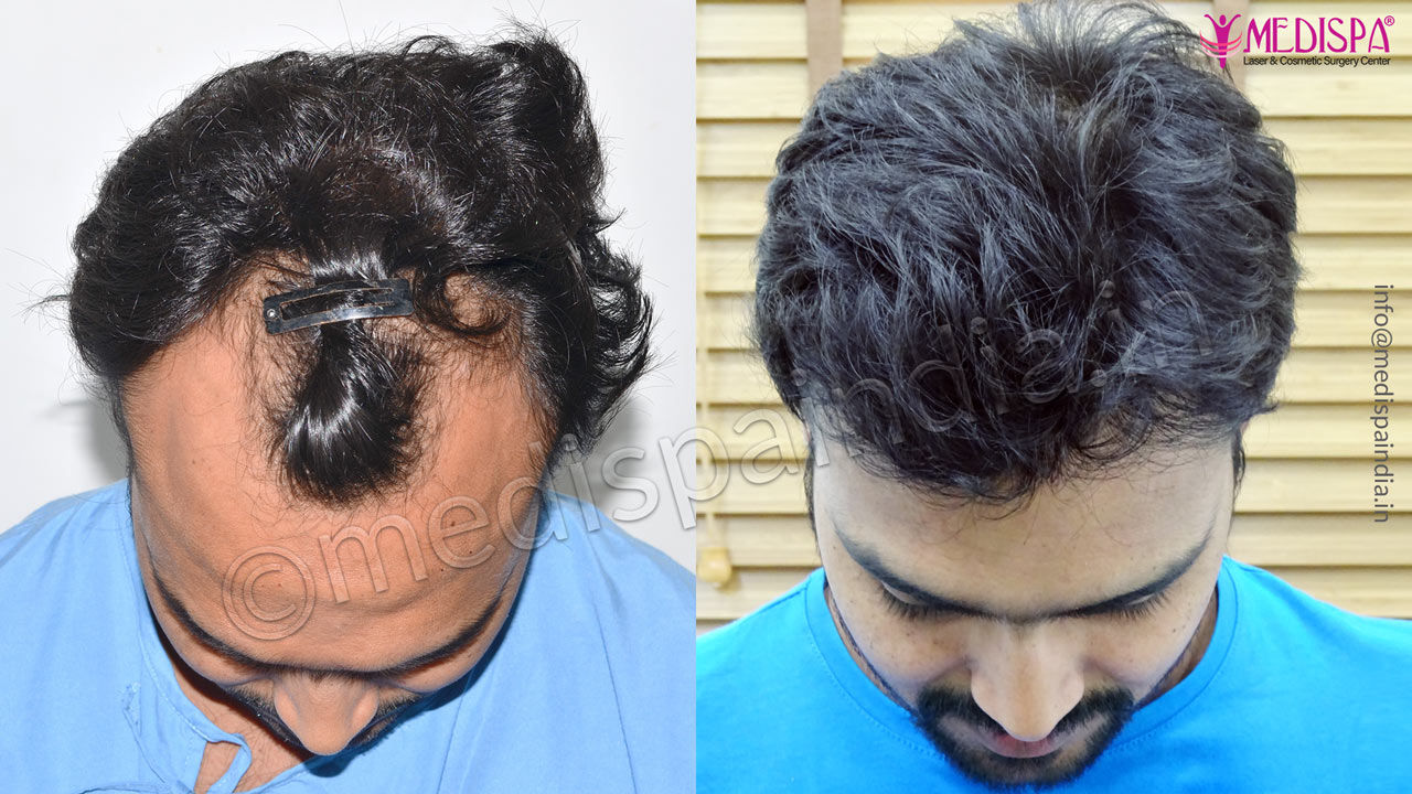 top hair transplant clinics in mumbai top hair transplant clinics in mumbai