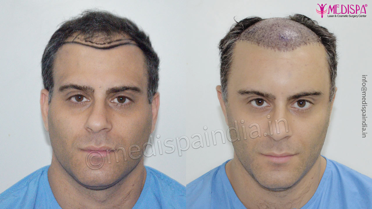 International Hair Transplant After Before Results