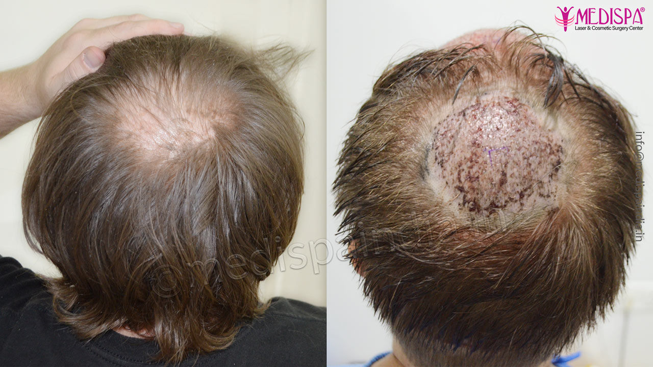 USA Male Hair Transplant Results Before & After Photos