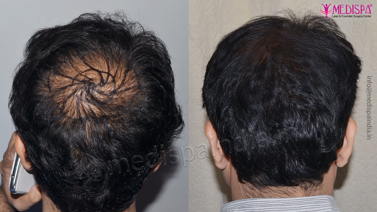 Crown Area Hair Transplant  Everything You Should Know  Otek Hair Clinic