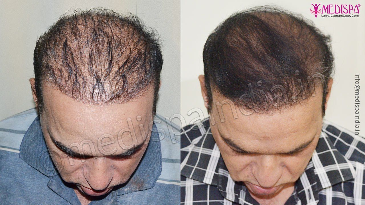 wrong hair transplant correction chennai