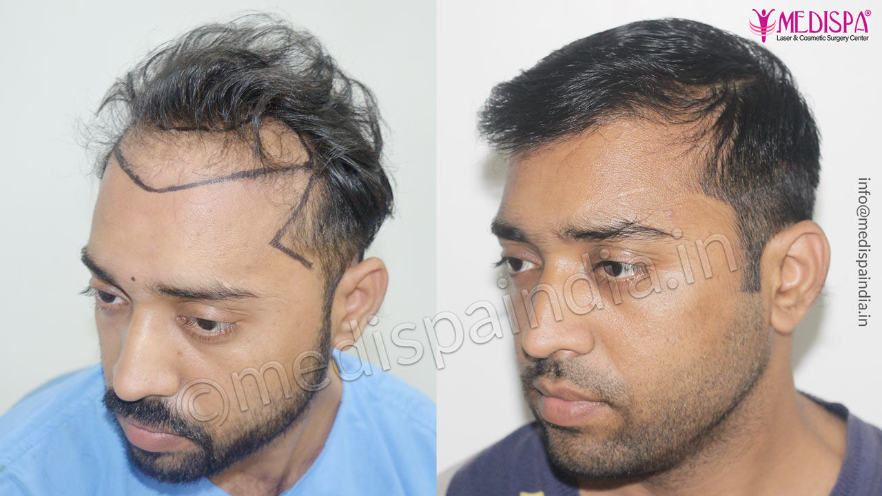 Before after hair transplant in Pune, Maharashtra, India Before after hair transplant in Pune, Maharashtra, India