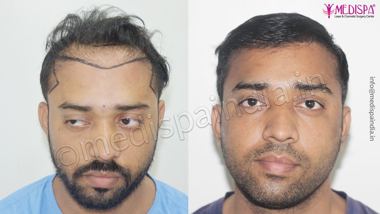Before after hair transplant in Pune, Maharashtra, India