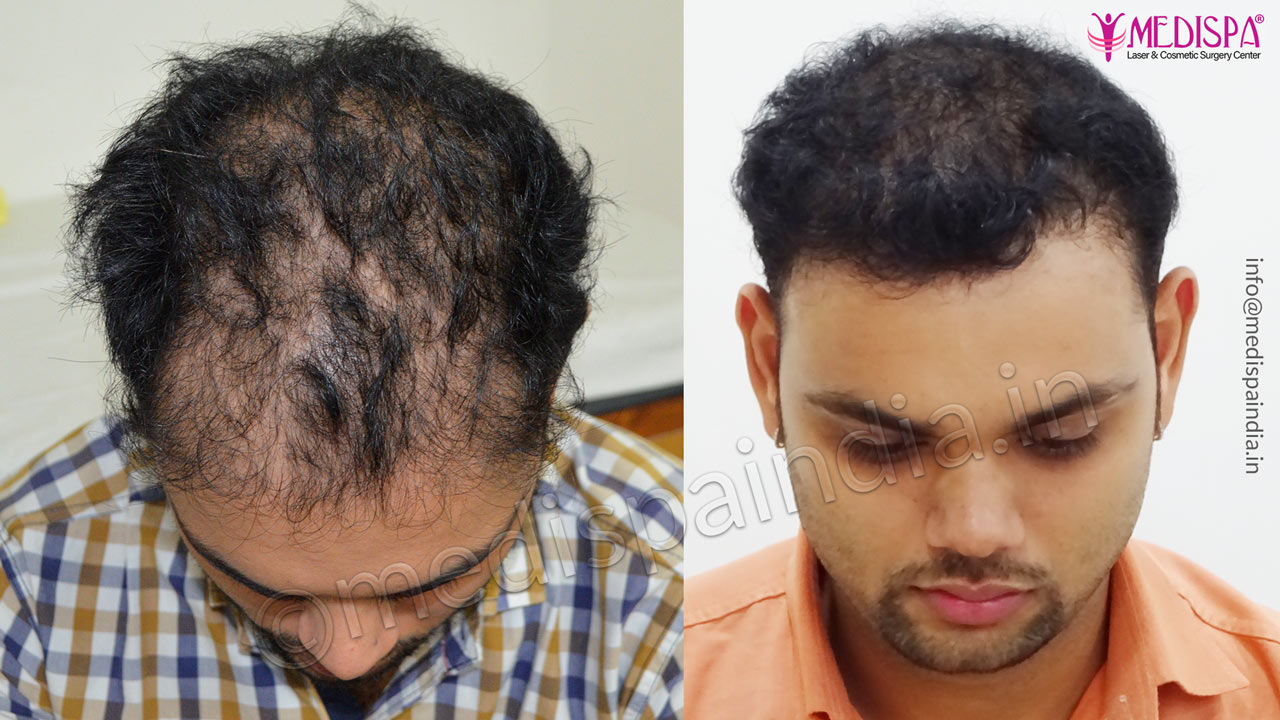 Hair Transplant Cost in Guwahati  Get Best Price