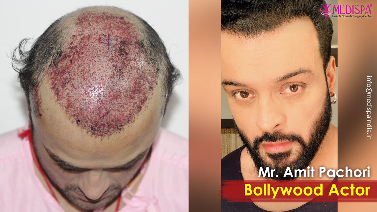 Bollywood Actor Amit Pachori Hair Transplant Results, Medispa