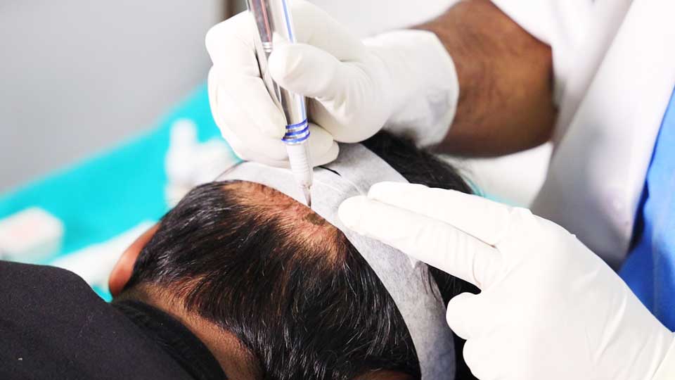 Scalp micropigmentation