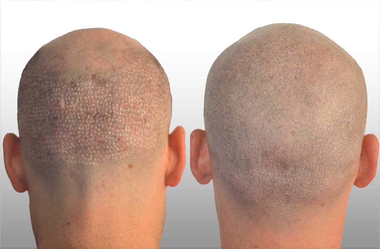Scalp Micropigmentation Benefits Side Effects Before  After Pics