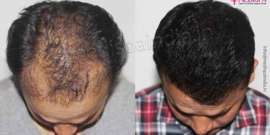 hair-transplant-results-in-jaipur