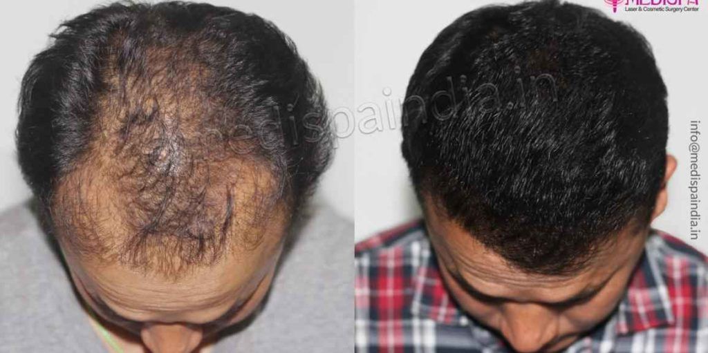 What Is Hair Transplant And Is Hair Transplant Permanent