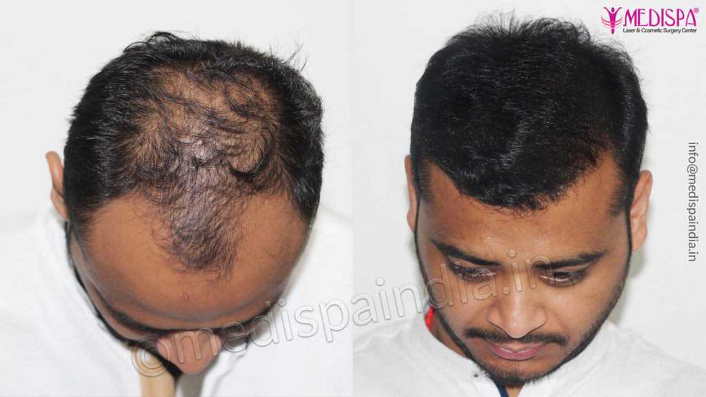 Hair Transplant Ghaziabad Results