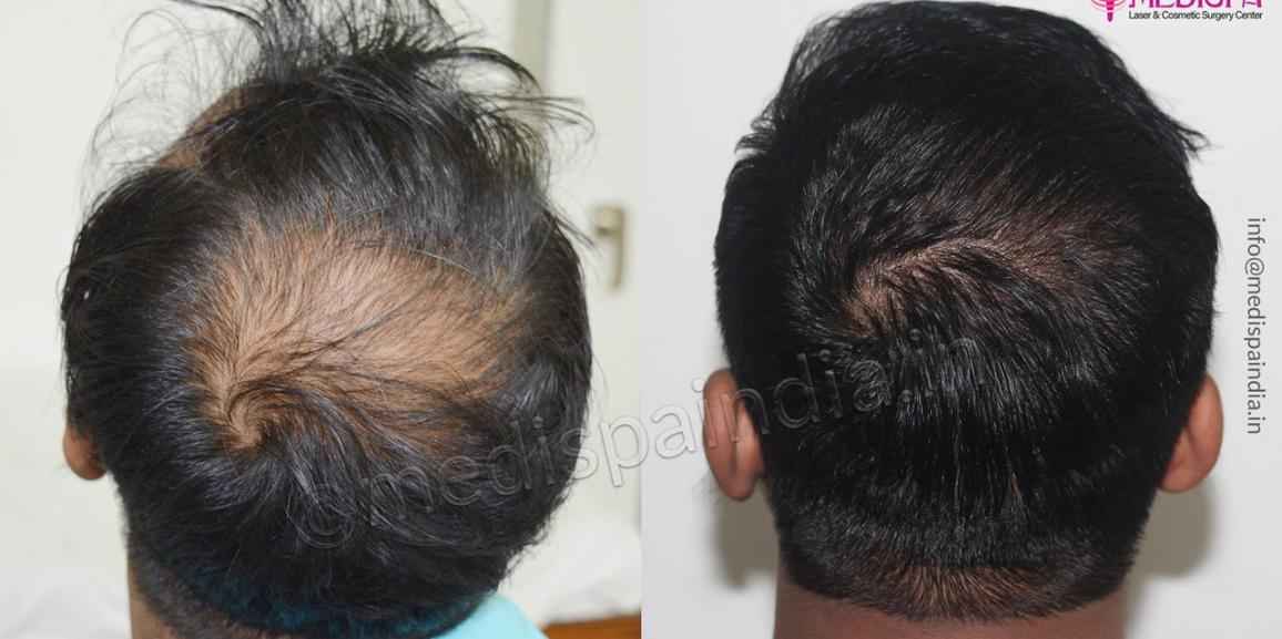 Best Hair Transplant in Mumbai Expert Surgeon  Best Cost