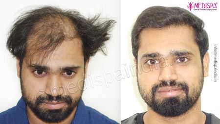 Hair Transplant Clinic in Bangalore