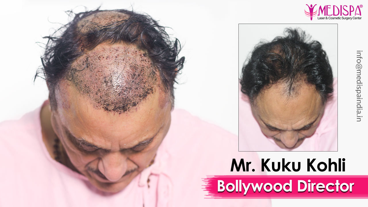 Celebrity Hair Transplant in India | Bollywood Actors Hair Transplant