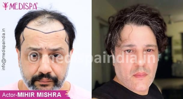 Hair Transplant in Jaipur | Hair Transplant Cost in Jaipur |