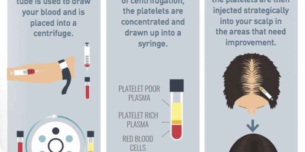 Importance of Platelet-Rich Plasma For Hair Restoration Importance of Platelet-Rich Plasma For Hair Restoration