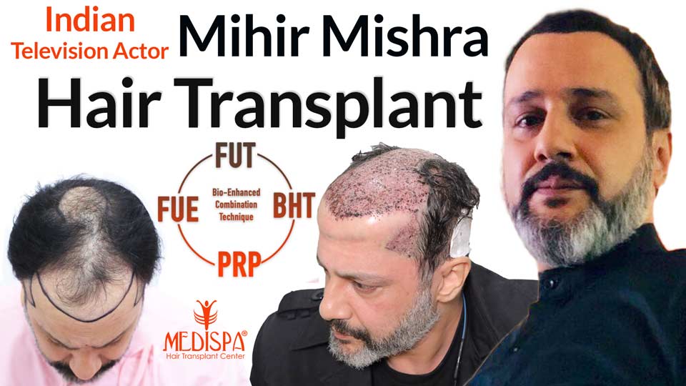 Celebrity Hair Transplant In India