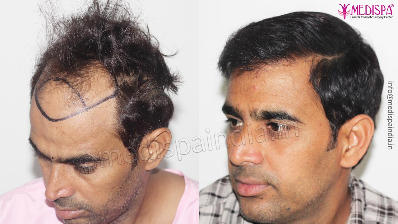 Hair Transplant Results, Indore at Medispa Jaipur Hair Transplant Results, Indore at Medispa Jaipur