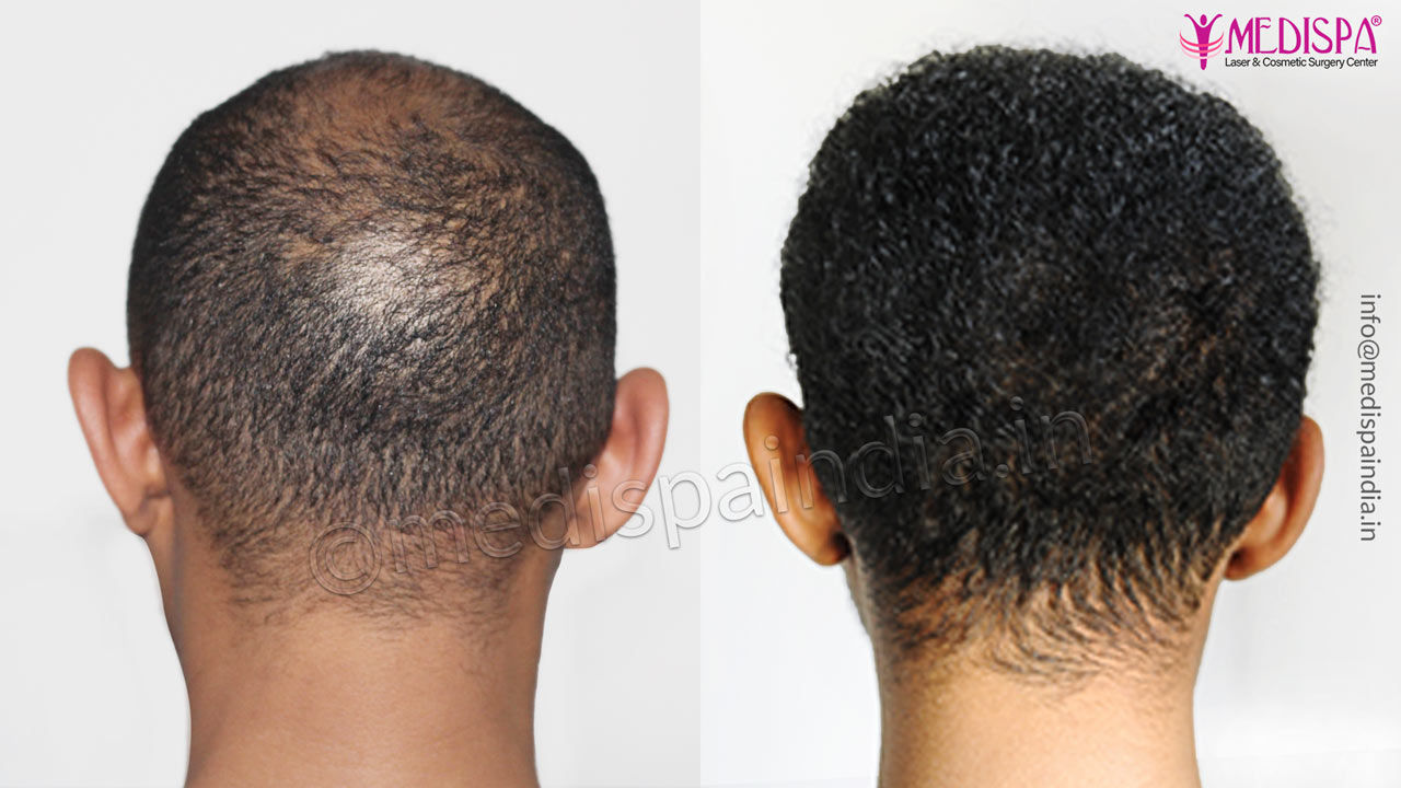 Can I Wear Skull Cap After Hair Transplant  Asli Tarcan Clinic