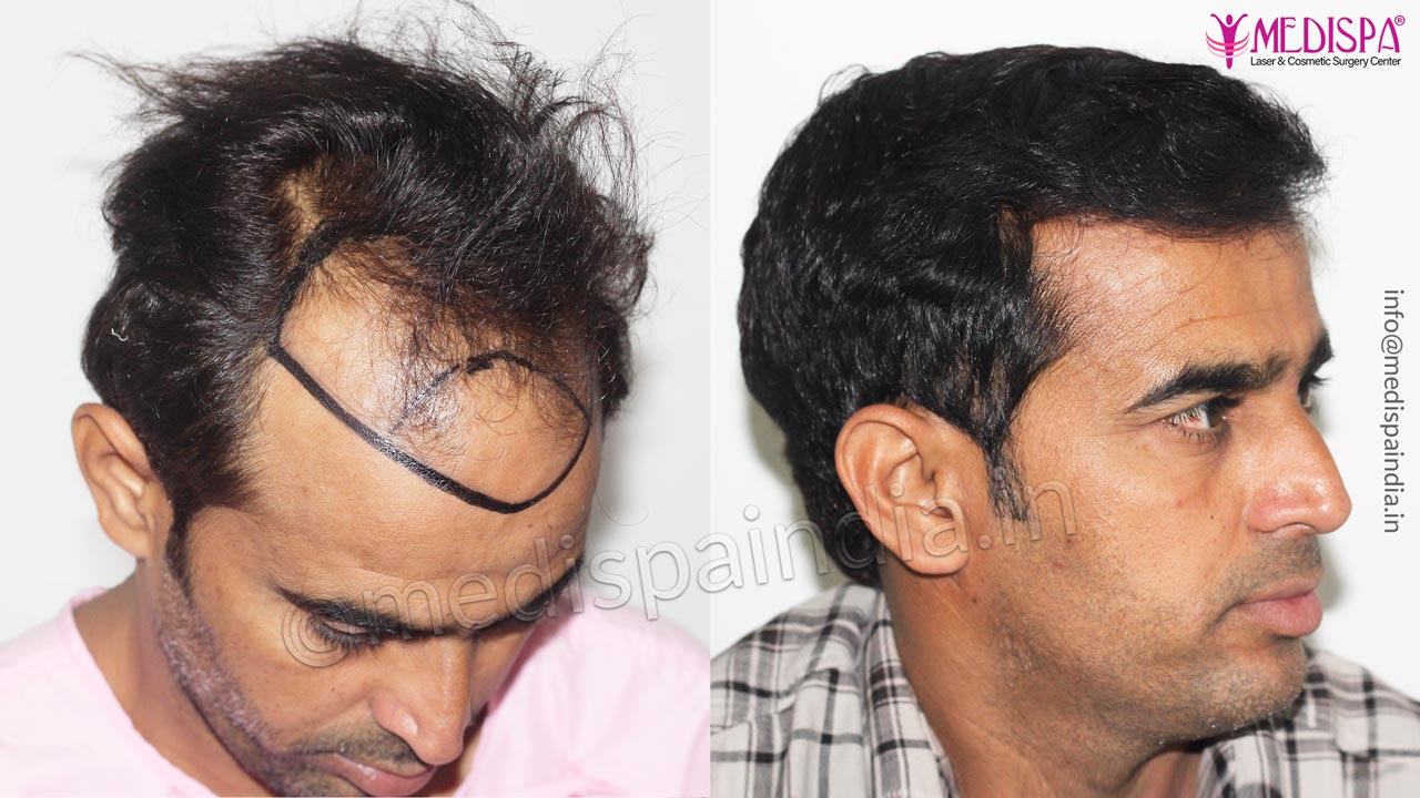 Hair Transplant Results, Indore at Medispa Jaipur Hair Transplant Results, Indore at Medispa Jaipur