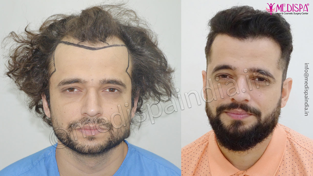 Hair Transplant Sydney 6900GST for 1500 grafts FUE  Dr Daood