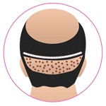 Hair Transplant in Bangladesh  Hair Transplant Cost Bangladesh