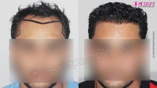 Unshaven FUE Hair Transplant UFUE  The Treatment Rooms London