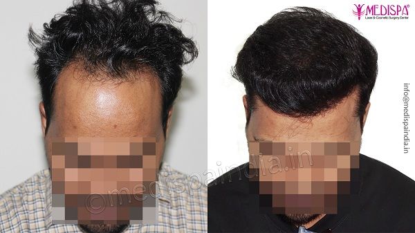 Hair Transplant Doctors in Mangalore  View Cost Book Appointment Consult  Online