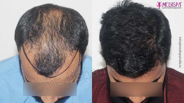 Hair Transplant in Pune at Best Cost by Expert Surgeon