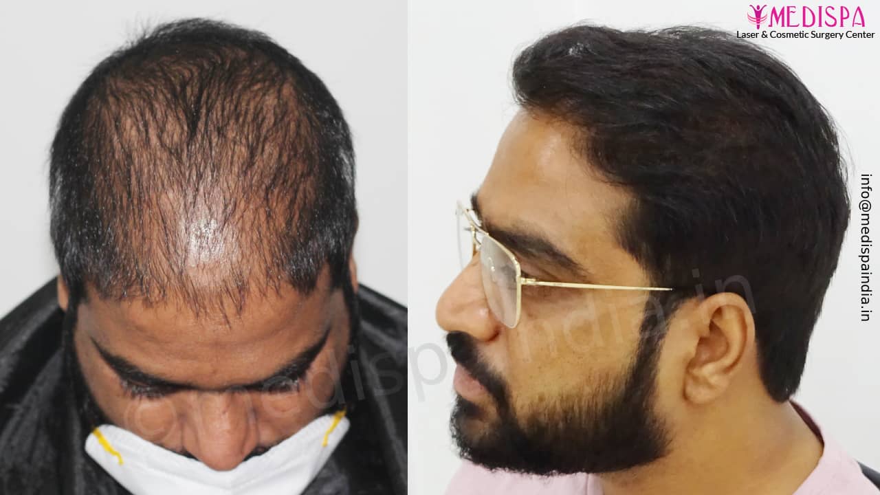 Best India Hair Transplant Results Best India Hair Transplant Results