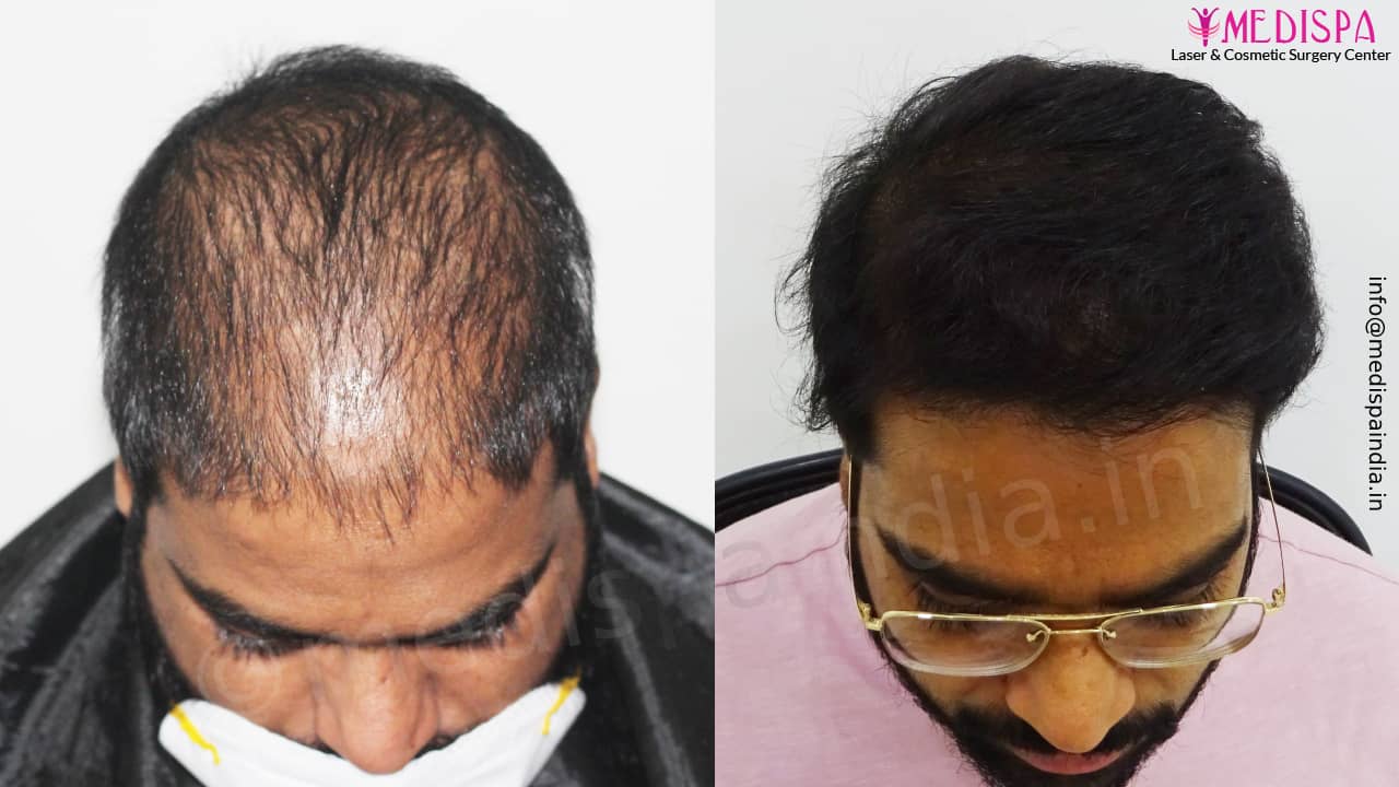 Best India Hair Transplant Results Best India Hair Transplant Results